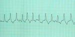 <p>na EKG záznamu - jedná se o častou komplikaci při onemocnění srdečního svalu u velkých plemen, tzv. dilatační kardiomyopatii.</p>
<p> </p>